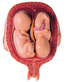 MS 12/8 Uterus mit Zwillingsfeten im 5. Monat
