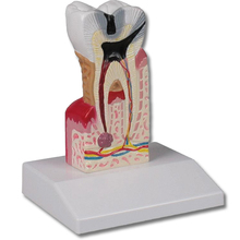 Zahnkariesmodell, 10-fache Größe